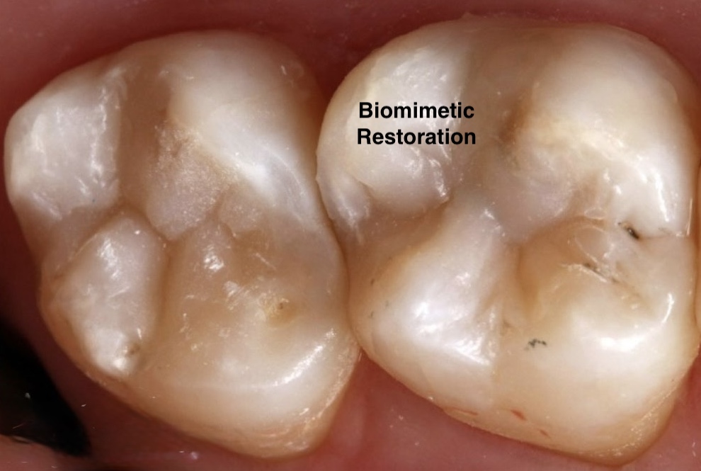 Biomimetic Restoration showing seamless integration