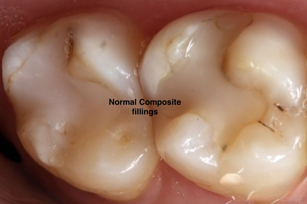Normal Composite fillings showing leakage and cracks