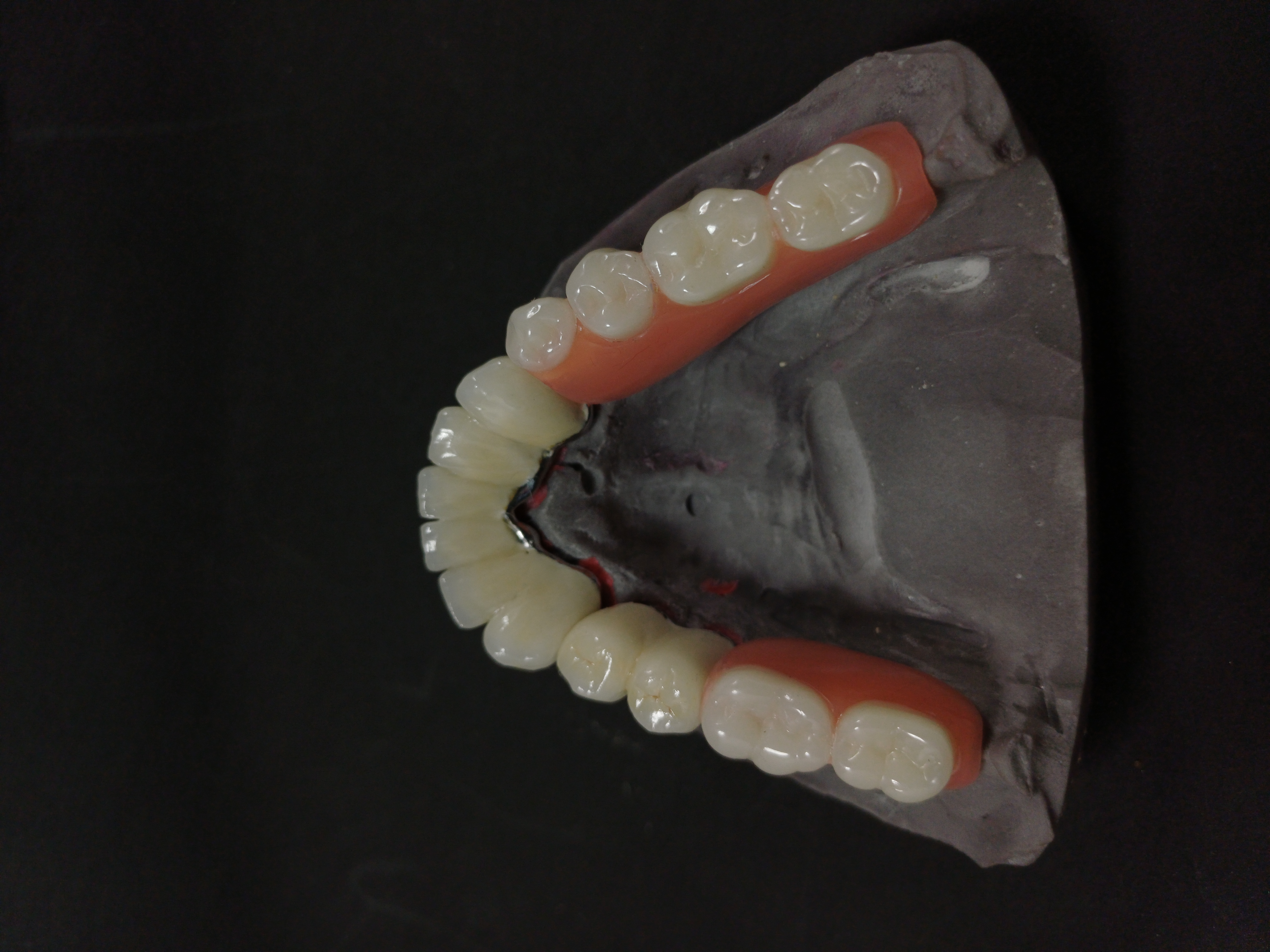 Precision Attachment Denture Case 1