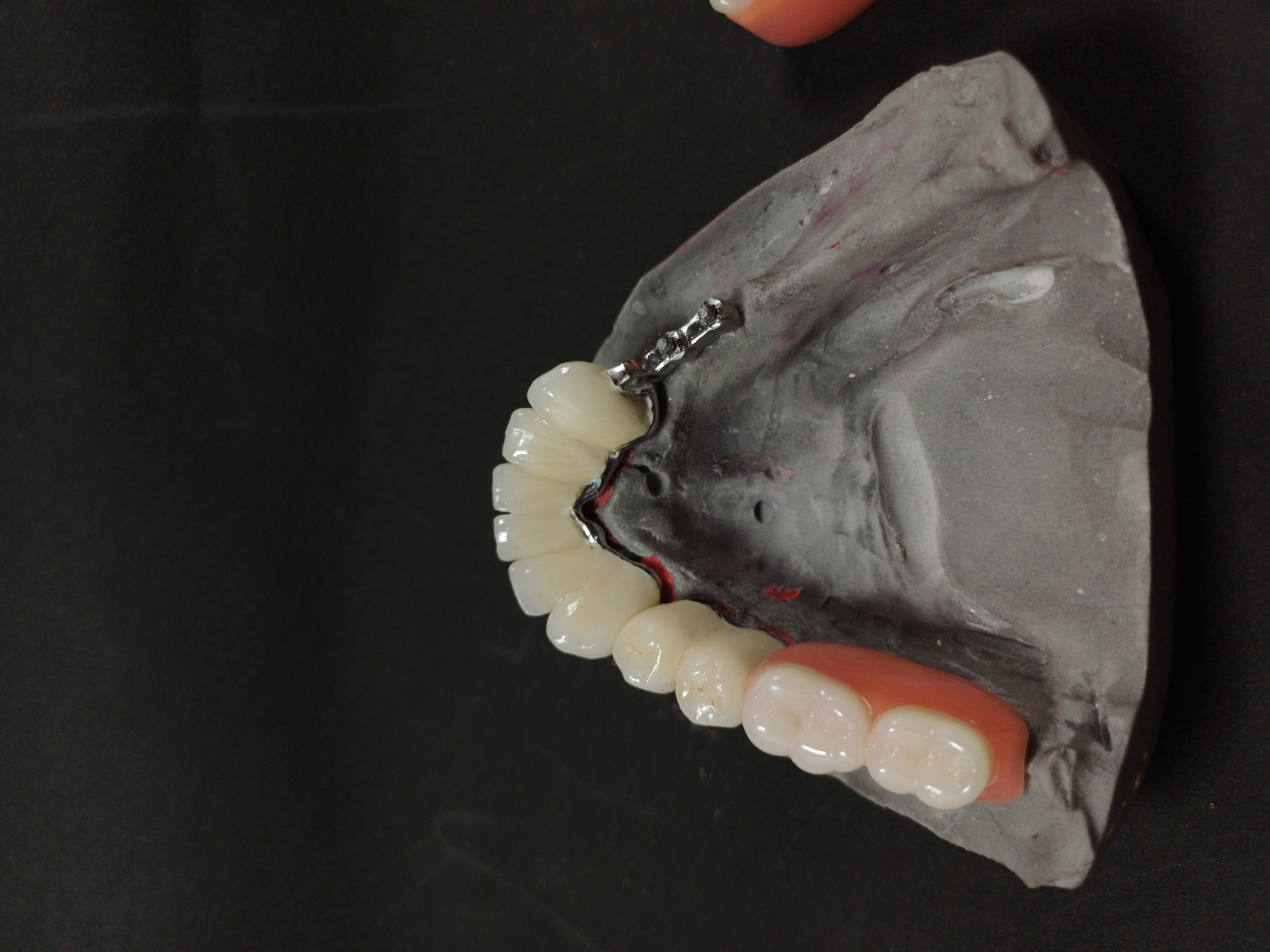 Precision Attachment Denture Case 3